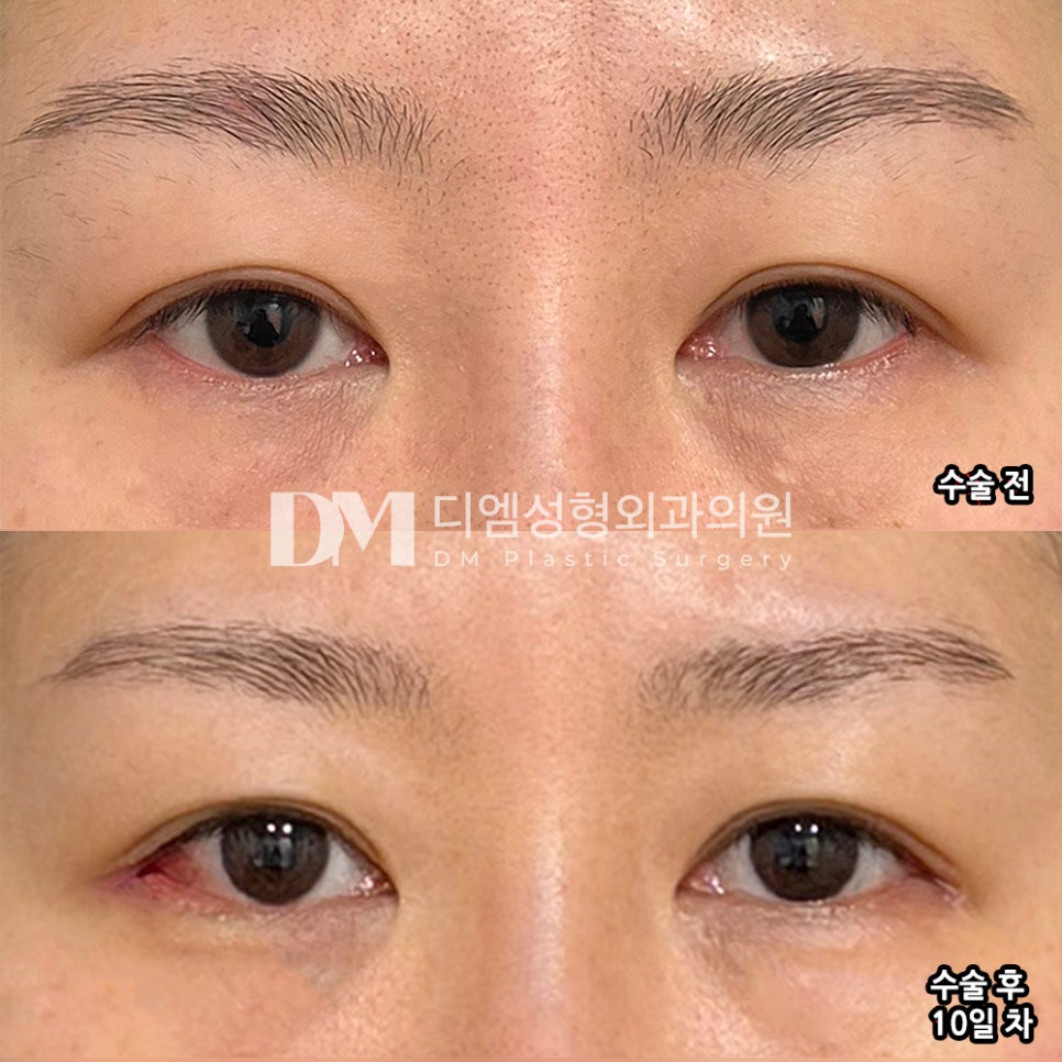 디엠 뒤밑트임 수술후기, &ldquo;과잉 진료 없었고 시술 후에도 신경 쓰이는 부분 없었습니다!&rdquo; 관련 이미지 2