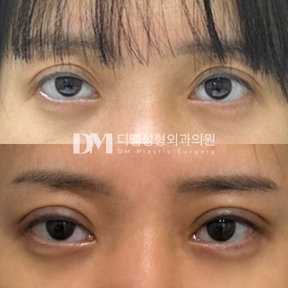 Eye Surgery Review: “It’s only been a month, but I think the crease is taking shape nicely!” image 2