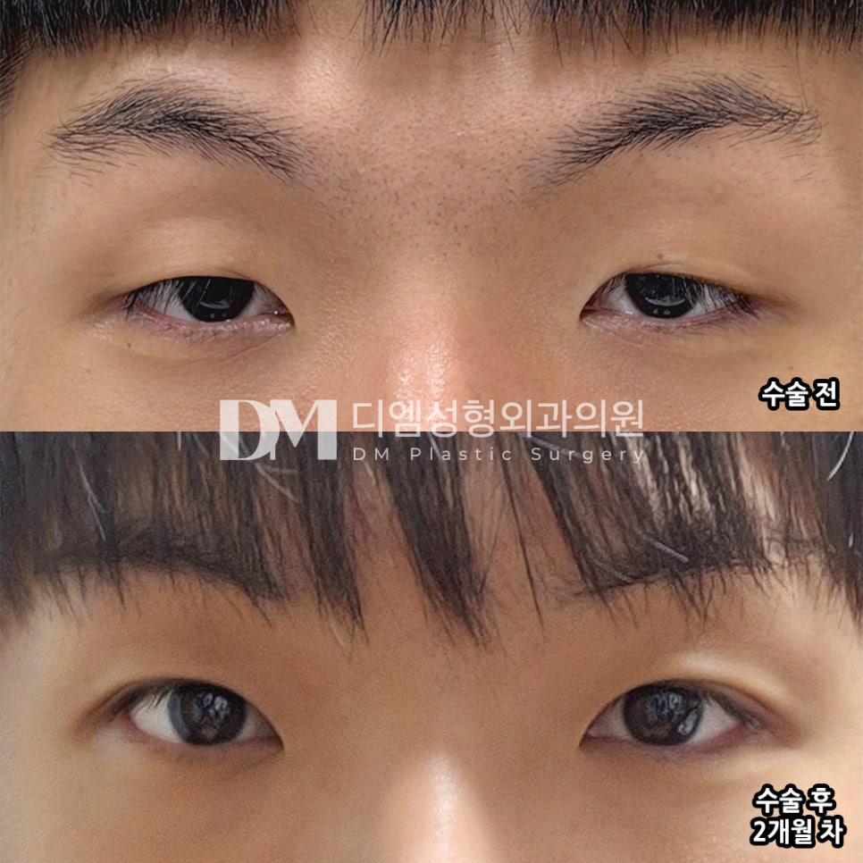 디엠 남자눈매교정/남자눈성형 후기, &ldquo;인상이 많이 좋아졌고 너무 만족스럽습니다!&rdquo; 관련 이미지 2