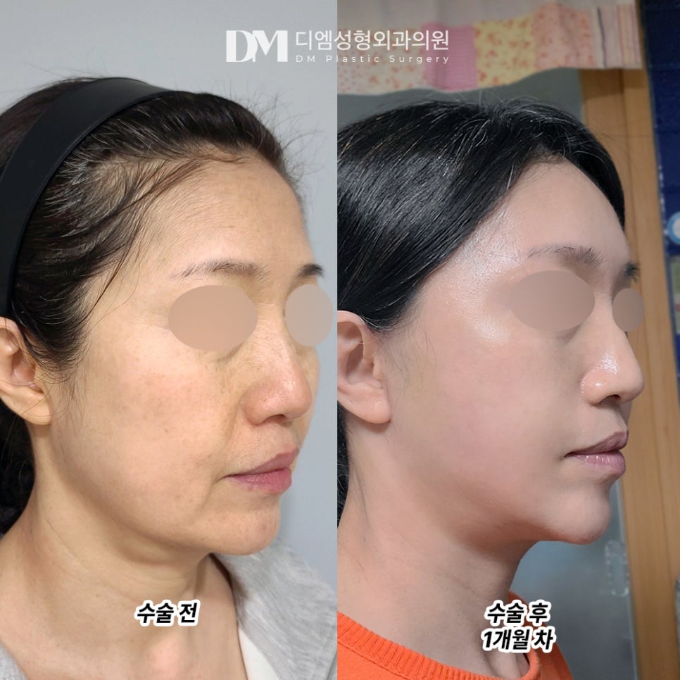 DM Facelift Before-and-After Photos, End the Stress of Deepening Wrinkles and Lost Elasticity! image 3