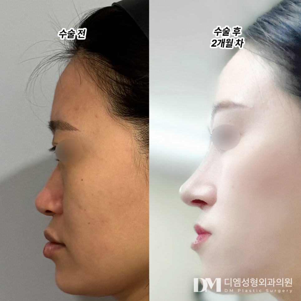 코성형 후기."더 이뻐졌다고 해서 너무 기분 좋아요!" 관련 이미지 2