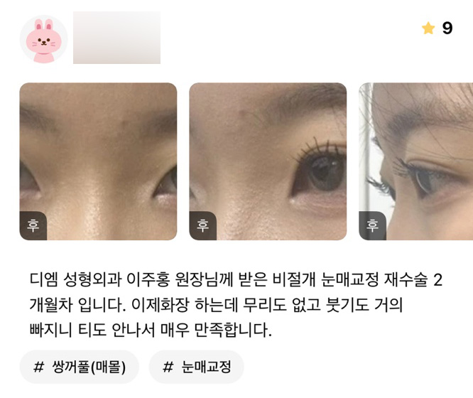 Double Eyelid Surgery Review: “I’m very satisfied because applying makeup is no longer difficult, and with most of the swelling gone, it’s hardly noticeable!” image 1