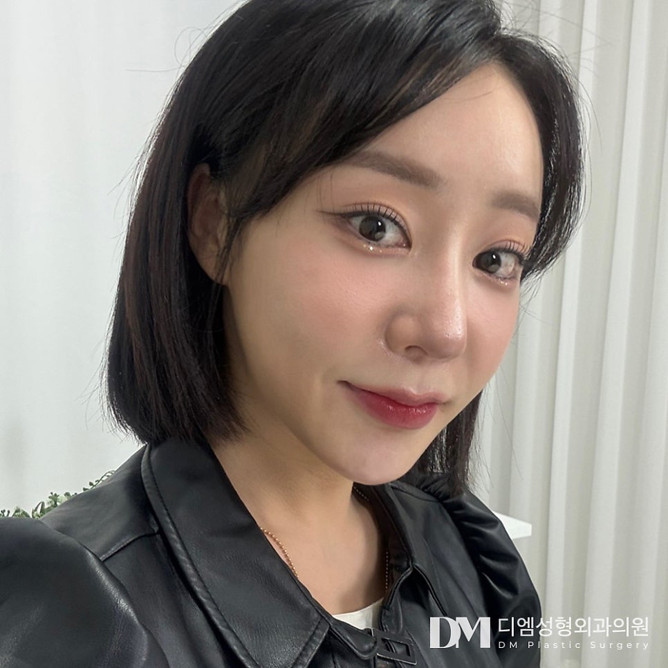 이마거상, 이마주름과 처진 눈모양 동시 개선하기! 관련 이미지 1
