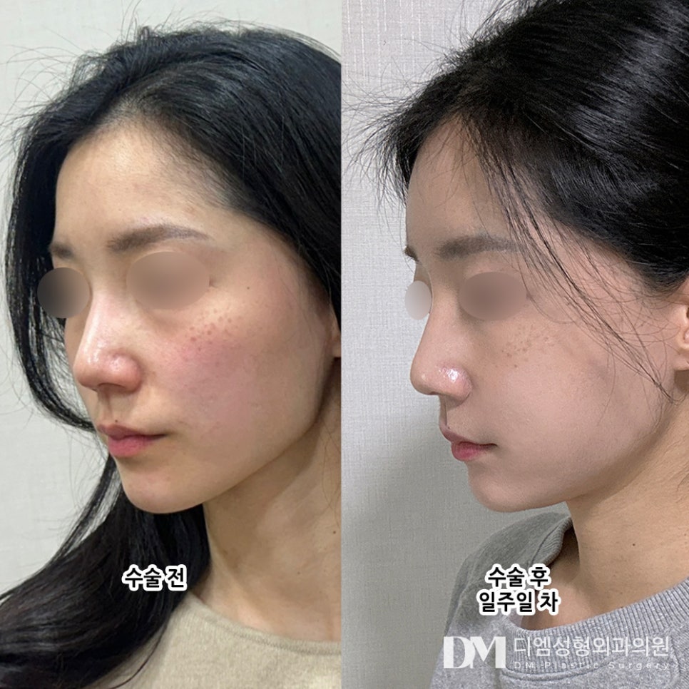 얼굴지방이식 후기."고민이던게 바로 해결되어서 너무 좋아요!" 관련 이미지 2
