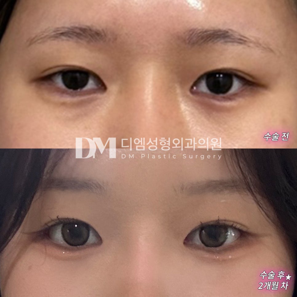 Bakngtim Review. “The stuffy feeling has mostly gone away, and it looks natural!” image 2