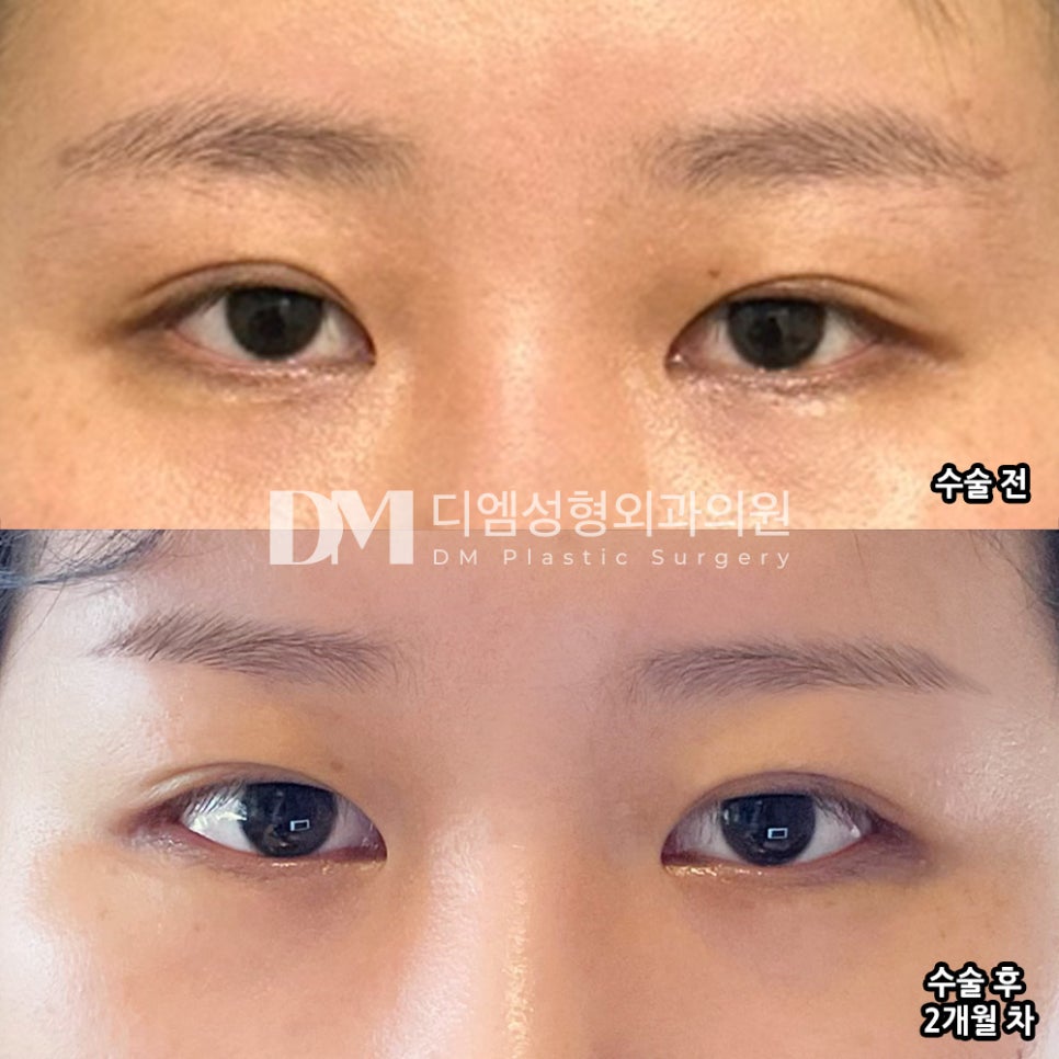 빵트임 후기."눈이 트이고 커진게 느껴져서 너무 좋아요!" 관련 이미지 2