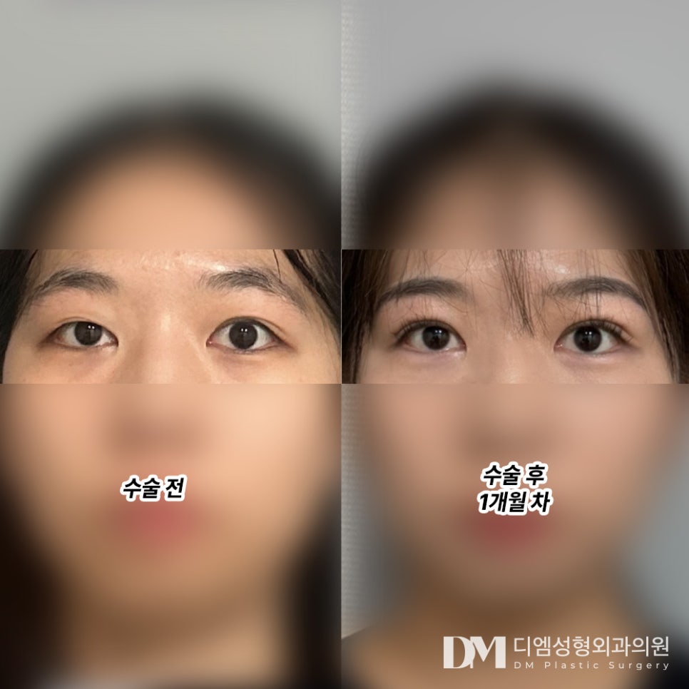 눈재수술 후기."인상도 또렷해졌다는 말 많이 들어서 자신감 생겼어요!" 관련 이미지 2