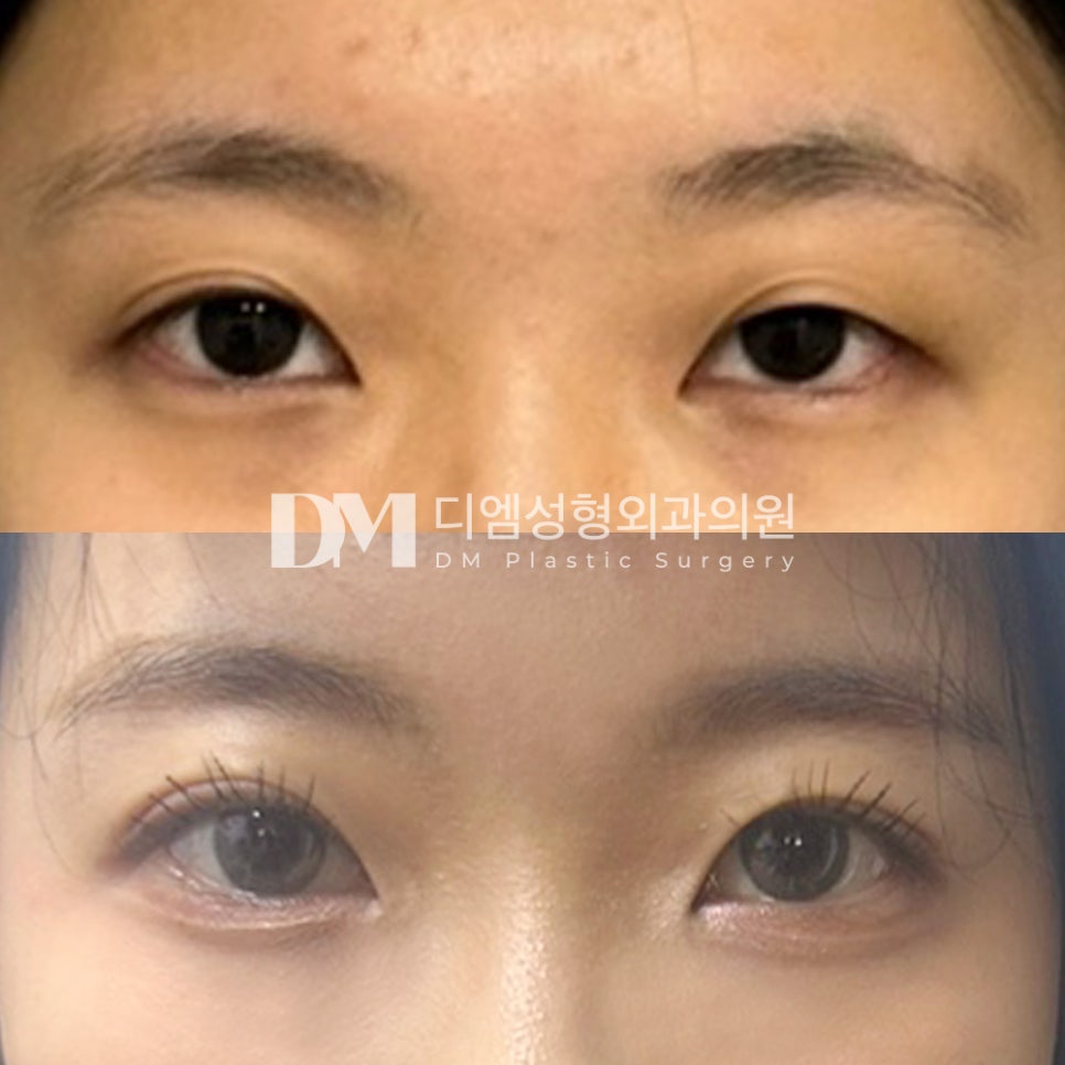 Double Eyelid Surgery Review: “I’m very satisfied because applying makeup is no longer difficult, and with most of the swelling gone, it’s hardly noticeable!” image 2