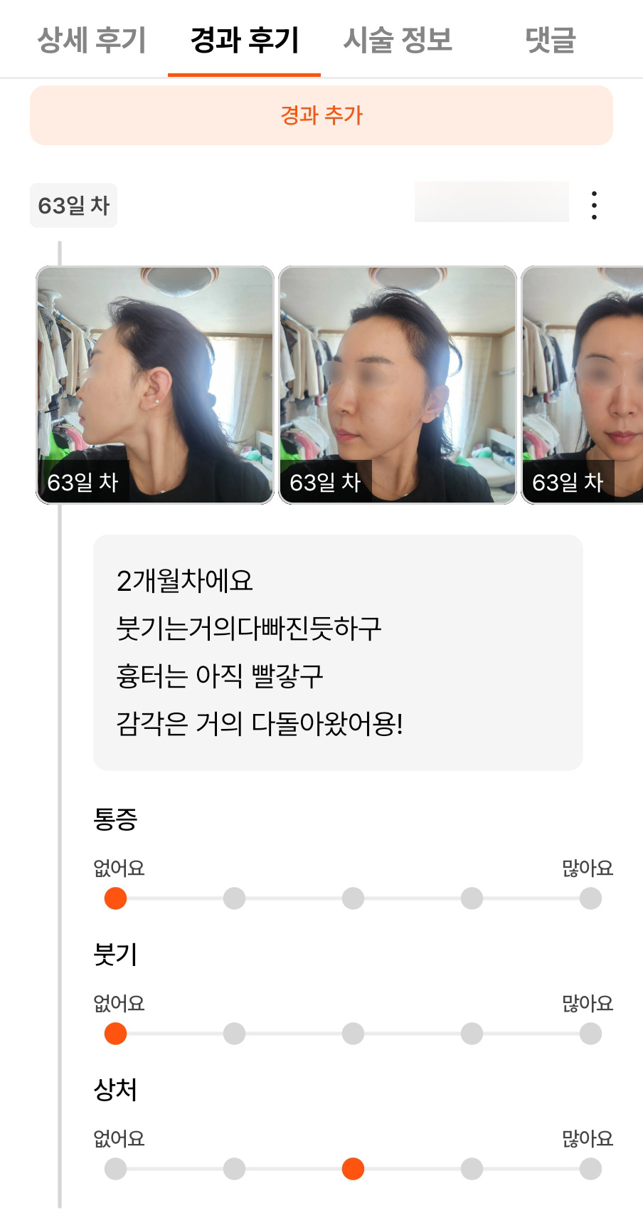 Mid-Facelift Review. "The swelling is all gone, and the sensation has fully returned!" image 1