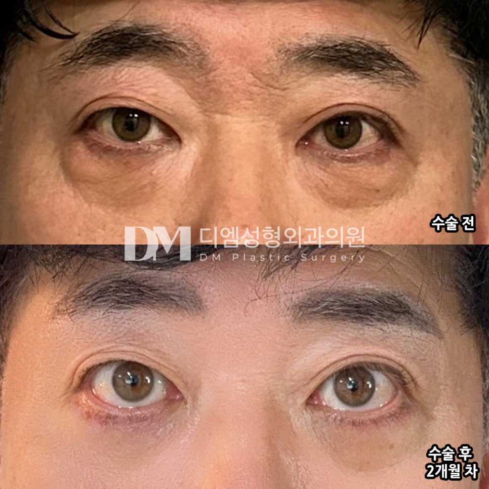 하안검 후기."강력히 추천하며 만족하고 있습니다 !" 관련 이미지 2