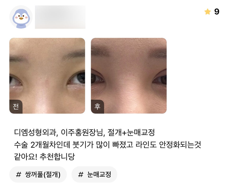 눈성형 후기."붓기도 많이빠졌고 라인도 자리잡아가는 것 같아요!" 관련 이미지 1