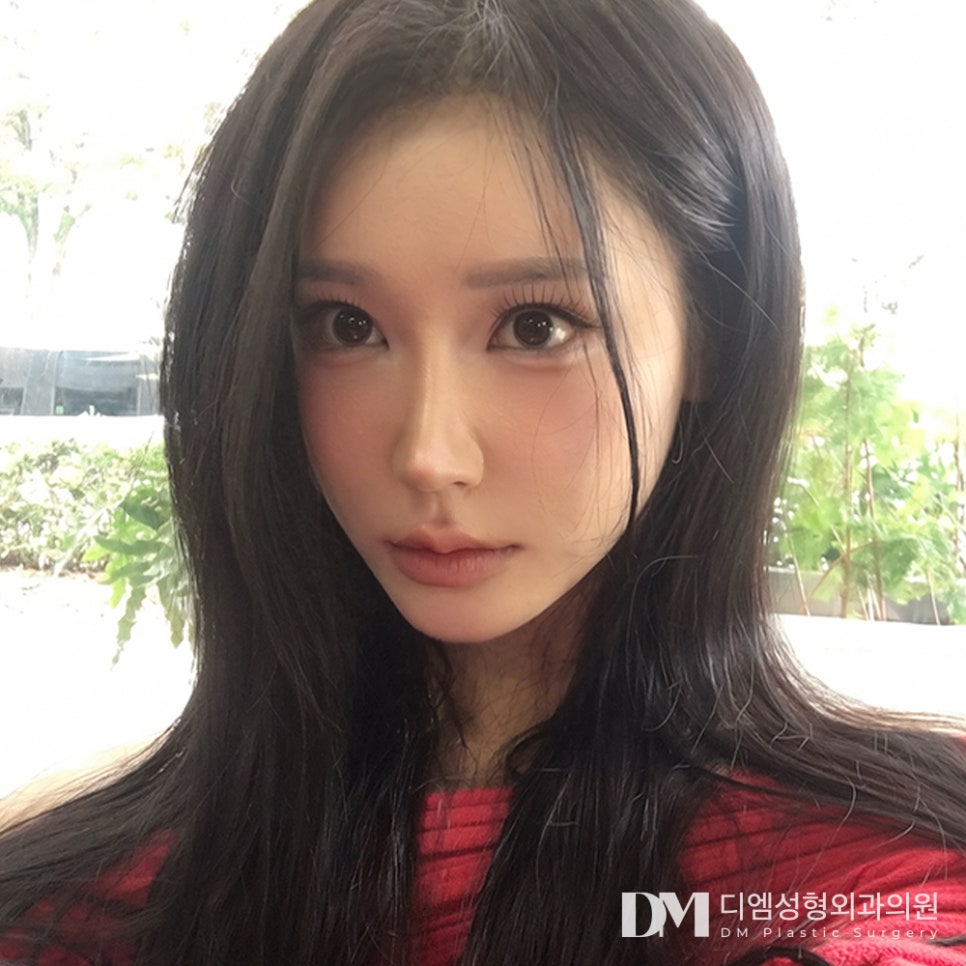 디엠 눈재수술 전후사진, 왜 더 신중해야 할까요? 관련 이미지 3