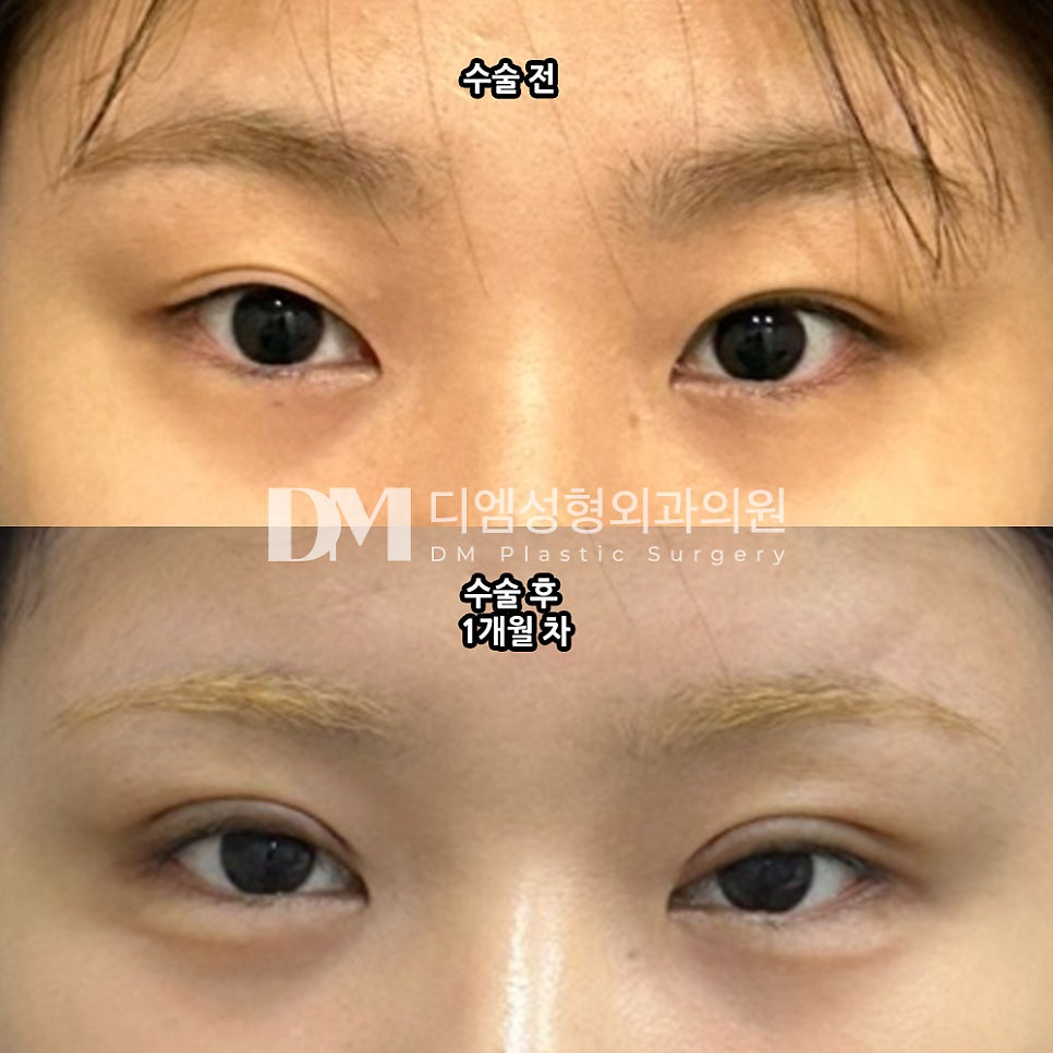Double-Eyelid Surgery Review: “I Love Both the Crease and the Degree of Canthoplasty!” image 2