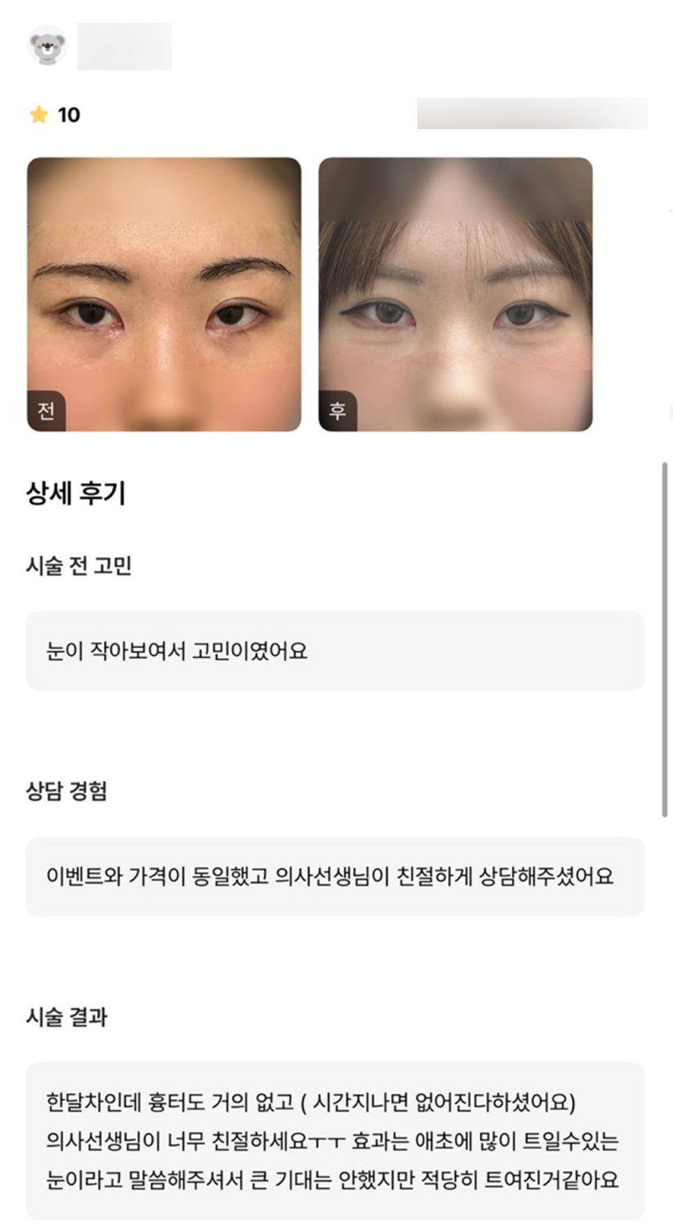 Lower Outer and Lower Corner Eye Opening Surgery Review. “There’s 거의 no scar, and I like that everyone is so kind!” image 1