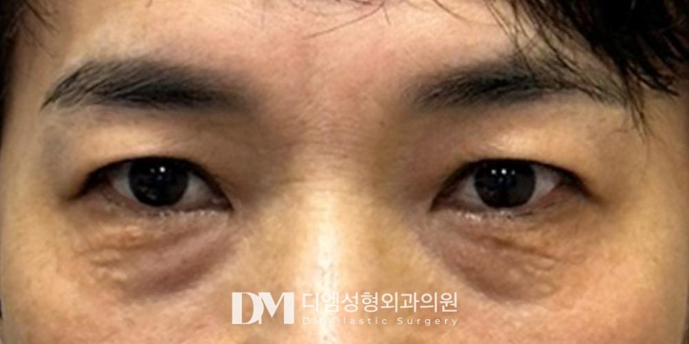 하안검, 눈밑지방이 불룩해 더 나이들어 보인다면? 관련 이미지 7
