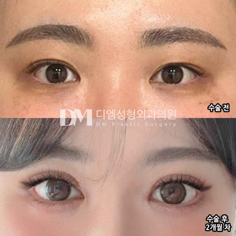 Revision Eyelid Surgery Review. "I was able to return to daily life quickly, and I’m very satisfied with the results!" image 2
