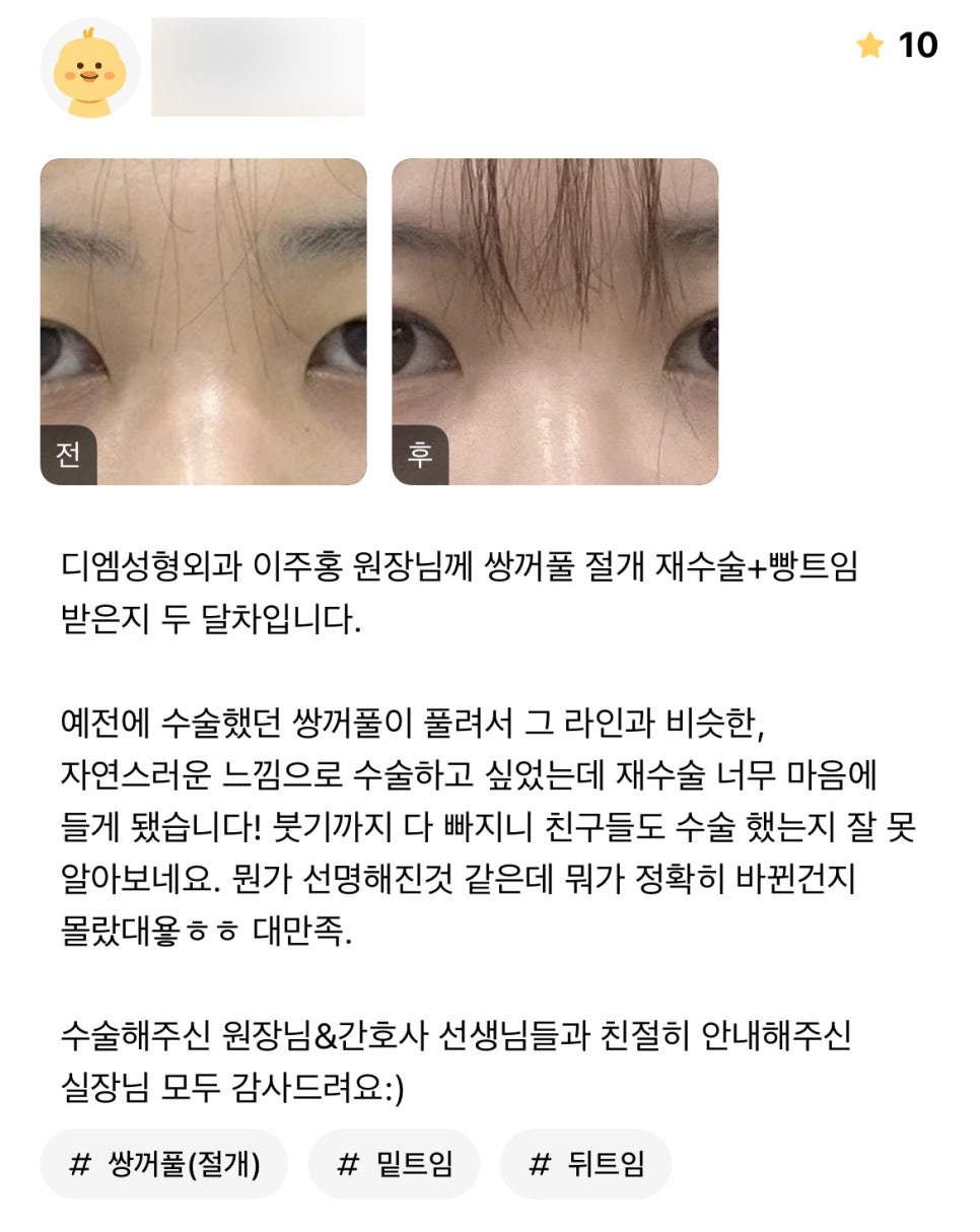 눈성형 후기."친구들도 수술했는지 몰라봐요! 대만족!" 관련 이미지 1