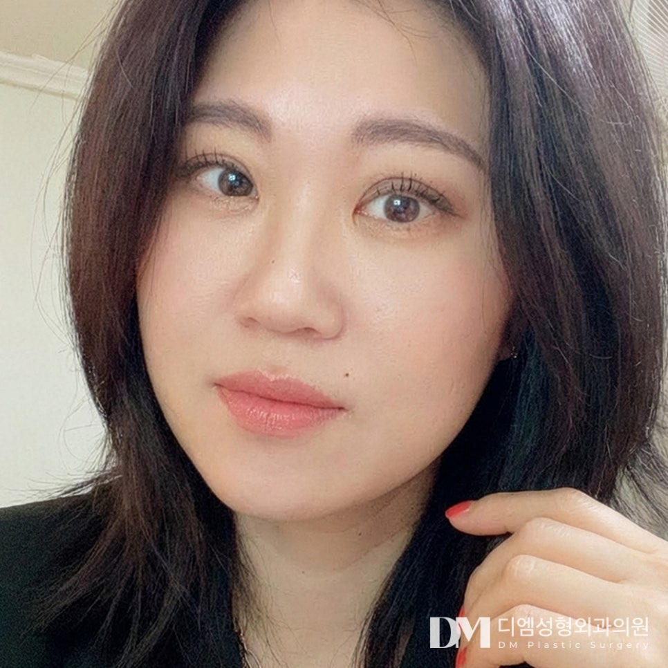 디엠 안면거상 전후사진, 무너진 얼굴 라인이 고민이라면? 관련 이미지 3
