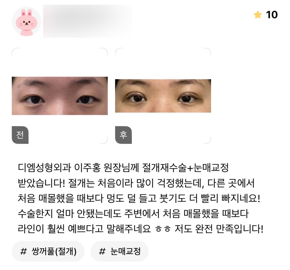 눈재수술 후기."첫 수술보다 라인도 훨씬 더 예쁘고 너무 만족스러워요!" 관련 이미지 1