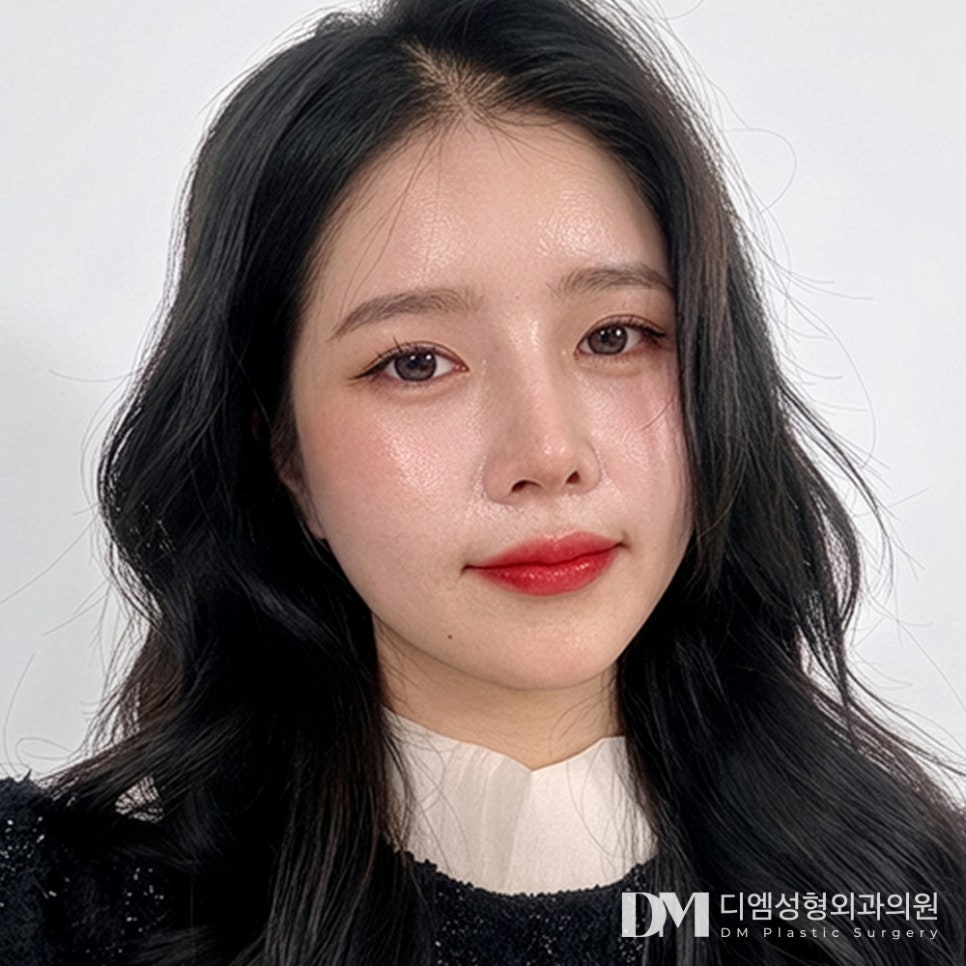 흉터 걱정 줄인 반거상과 안면거상의 차이점은? 관련 이미지 2