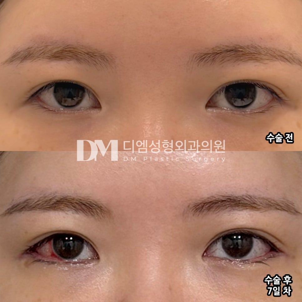 디엠 빵트임 수술후기, &ldquo;눈 커진 게 티나서 좋아요!&rdquo; 관련 이미지 2