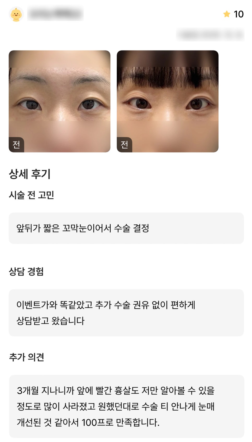 디엠 앞트임/뒤밑트임 수술후기, &ldquo;원했던 대로 눈매 개선된 것 같아 100프로 만족합니다!&rdquo; 관련 이미지 1