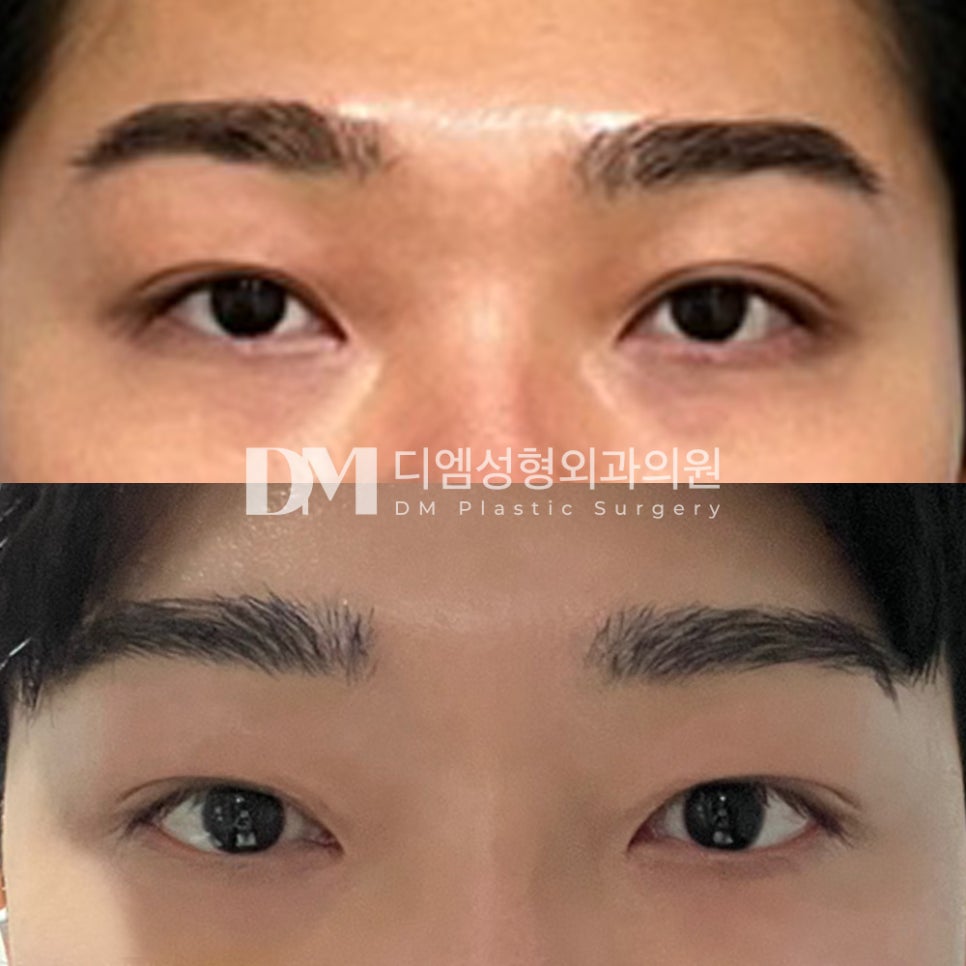눈성형 후기."니즈파악을 잘해주셨고 눈도 더 또렷해졌어요!" 관련 이미지 2