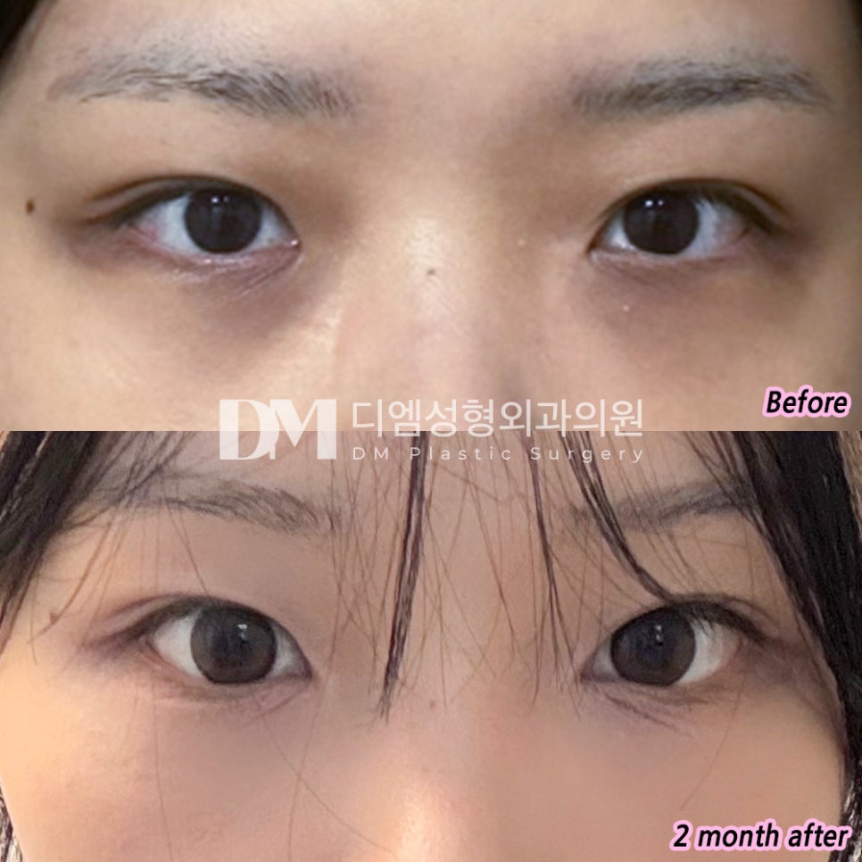 눈밑지방재배치 후기." 인상이 부드러워지고 얼굴도 전체적으로 환한 느낌이 되었어요!" 관련 이미지 2