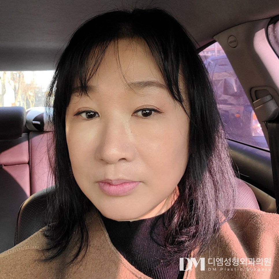 Correcting Sagging Eye Shape with Forehead Lift! image 1