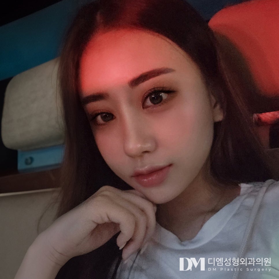 디엠 트임재수술 전후사진, 타 병원 수술 후 다시 찾는 이유는? 관련 이미지 1