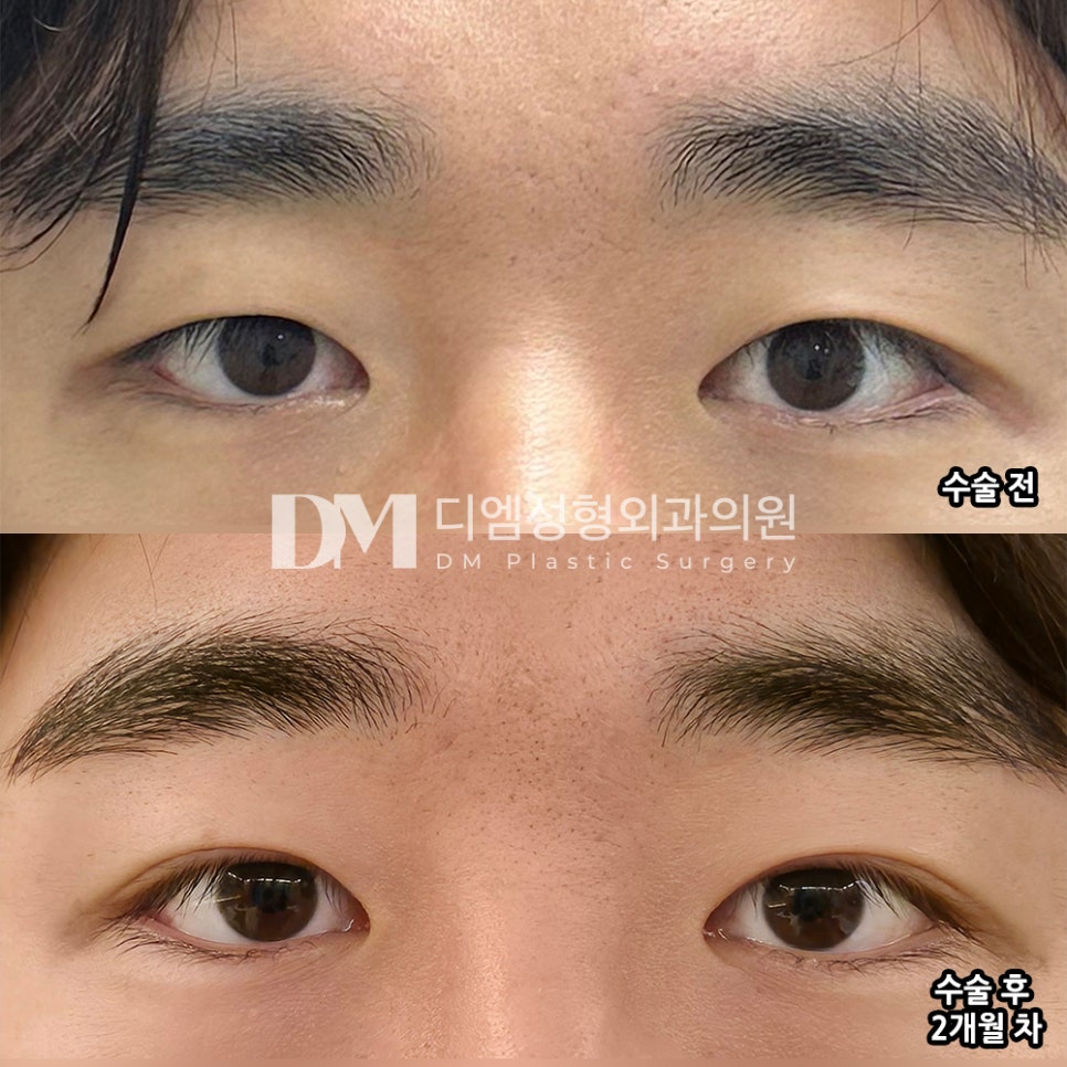 디엠 남자눈성형 전후사진, 부담스럽지 않게 또렷해지는 비결은? 관련 이미지 2