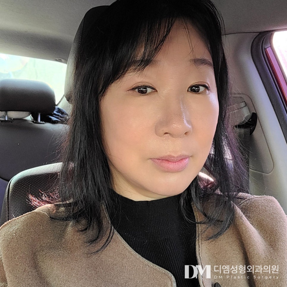안면거상으로 탄력 잃고 늘어진 피부 되살리기 관련 이미지 16