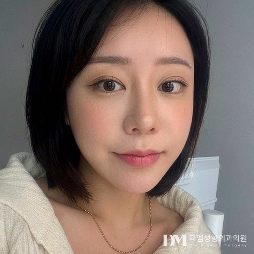 디엠 반거상 전후사진, 깊은 팔자주름이 고민이라면? 관련 이미지 3