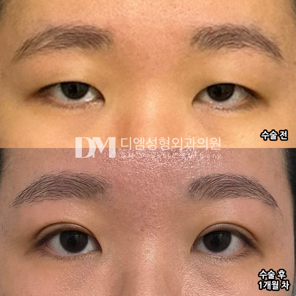 Eyelid Surgery Review. “I’m satisfied because the line was set exactly the way I wanted!” image 2