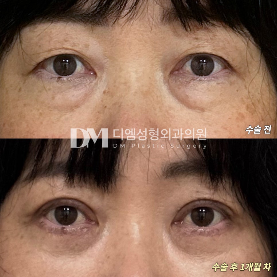 눈성형 후기."자연스레 잘 정리되어 좋아요!" 관련 이미지 2