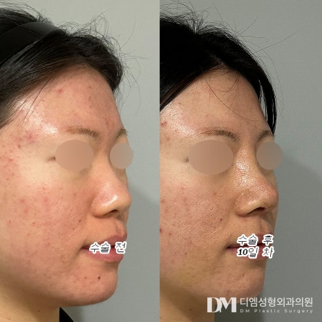 코성형 후기."콧대,코끝, 전체 밸런스까지 세심하게 봐주시고 코 전문으로 하셔서 그런지 믿음이 확 갔어요." 관련 이미지 3