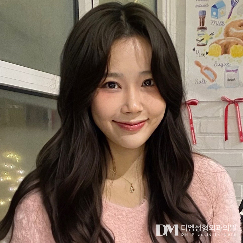 디엠 눈밑지방재배치 전후사진, 칙칙함 싹 지우고 환한 눈매로 변신! 관련 이미지 3