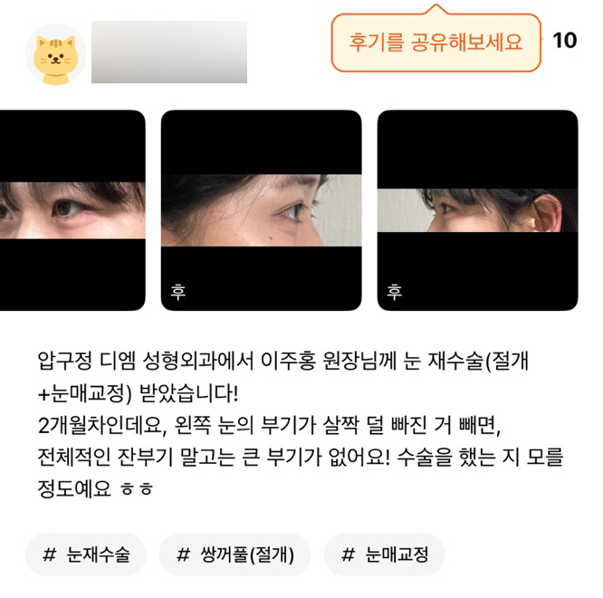 Revision Eye Surgery Review: “You can hardly tell I had surgery, haha!” image 1