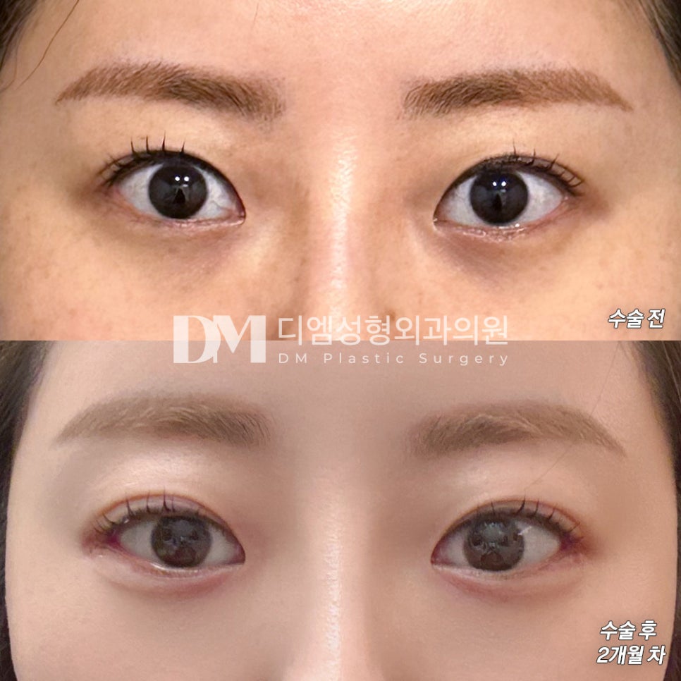 Post-Op Review of Lateral and Lower Canthoplasty. “Everyone was kind, and overall, I’m satisfied!” image 2