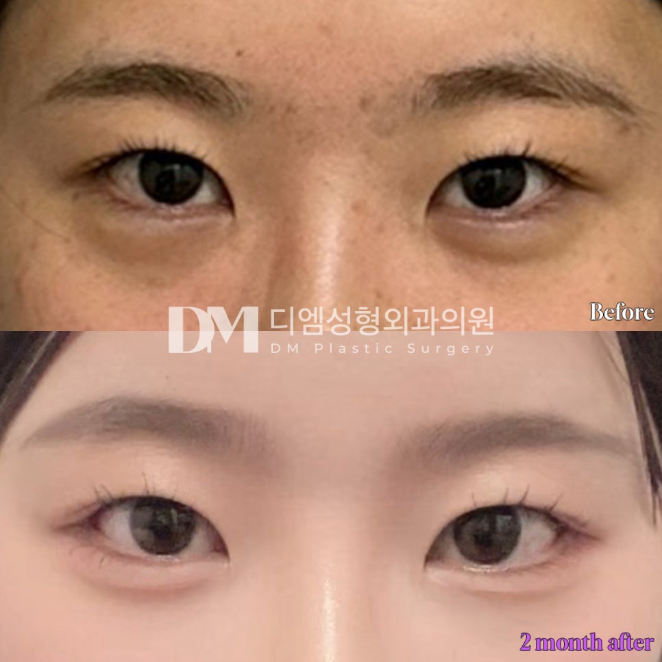 Outer Canthoplasty and Lower Canthoplasty at the Same Time! DM Outer & Lower Canthoplasty image 5