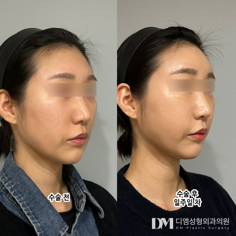 Facial Fat Grafting Review: “I’m Especially Satisfied That My Deeply Sunken Forehead Has Filled Out!” image 2