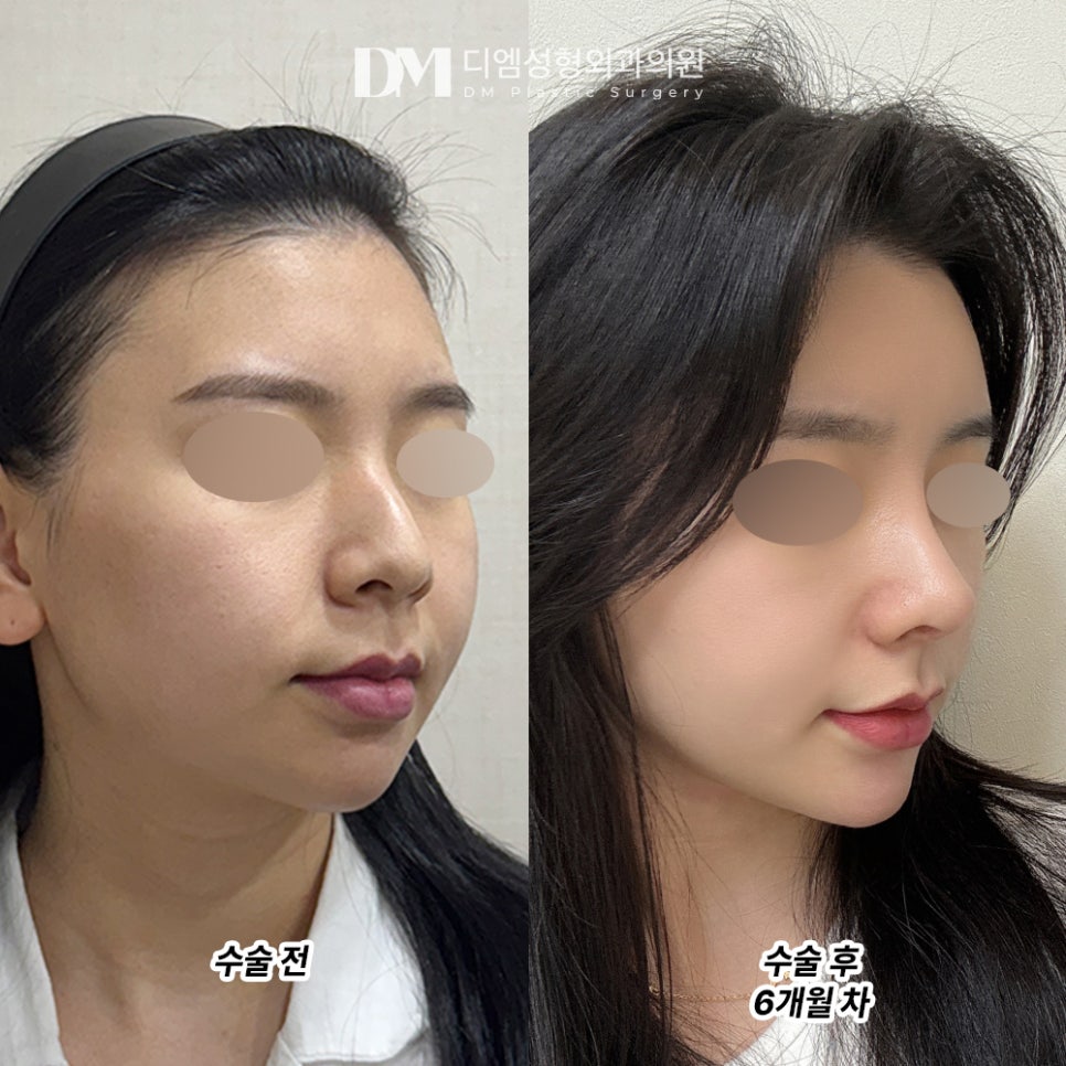 디엠 코성형 후기, &ldquo;붓기가 빠질수록 제가 원하는 느낌이 나와요!&rdquo; 관련 이미지 2