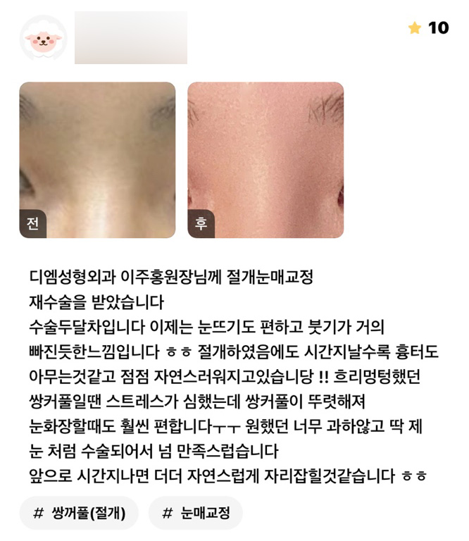 눈재수술 후기."너무 과하지않고 딱 제 눈처럼 수술되어서 넘 만족스럽습니다!" 관련 이미지 1