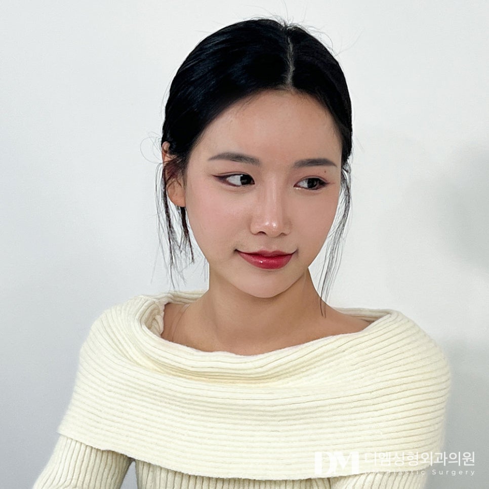 Short Nose Surgery: Improving an Awkward Side Profile in a More Three-Dimensional Way image 11