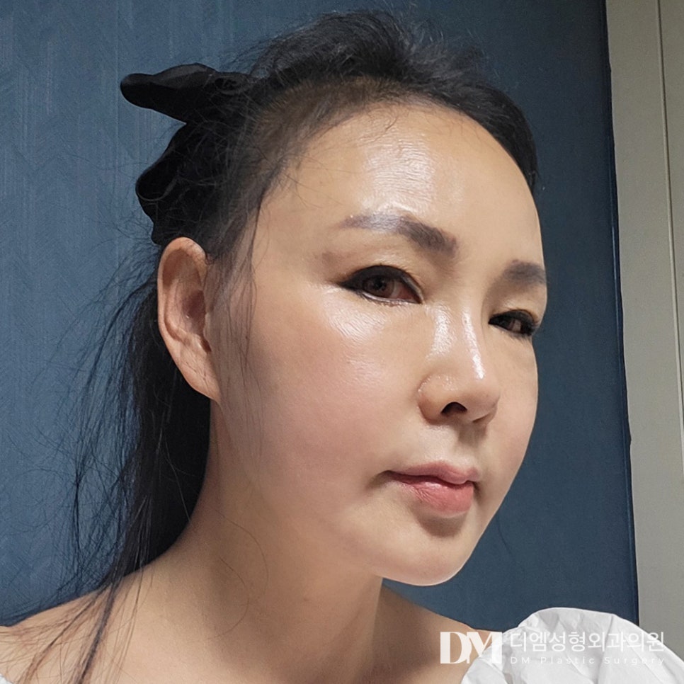 안면거상, 탄력을 잃은 피부가 고민이라면 관련 이미지 16