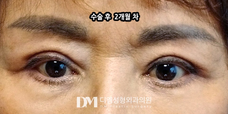 상안검, 처진 눈매 개선을 위한 중년 눈성형 관련 이미지 11