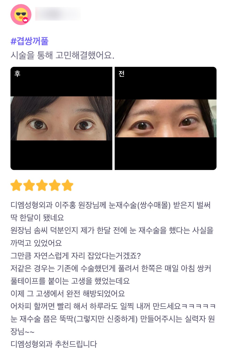 Double Eyelid Revision Surgery Review. "If you’re going to do it anyway, do it sooner and make it yours a day earlier!!" image 1