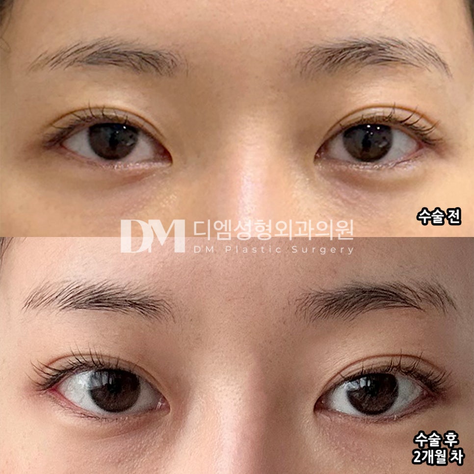 DM Lateral and Lower Canthoplasty Surgery Review, “I’m satisfied because it doesn’t look noticeable!” image 2