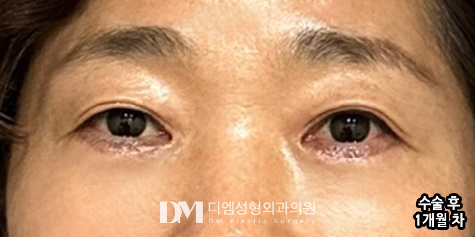 하안검, 눈 밑 노화가 고민이라면? 관련 이미지 8
