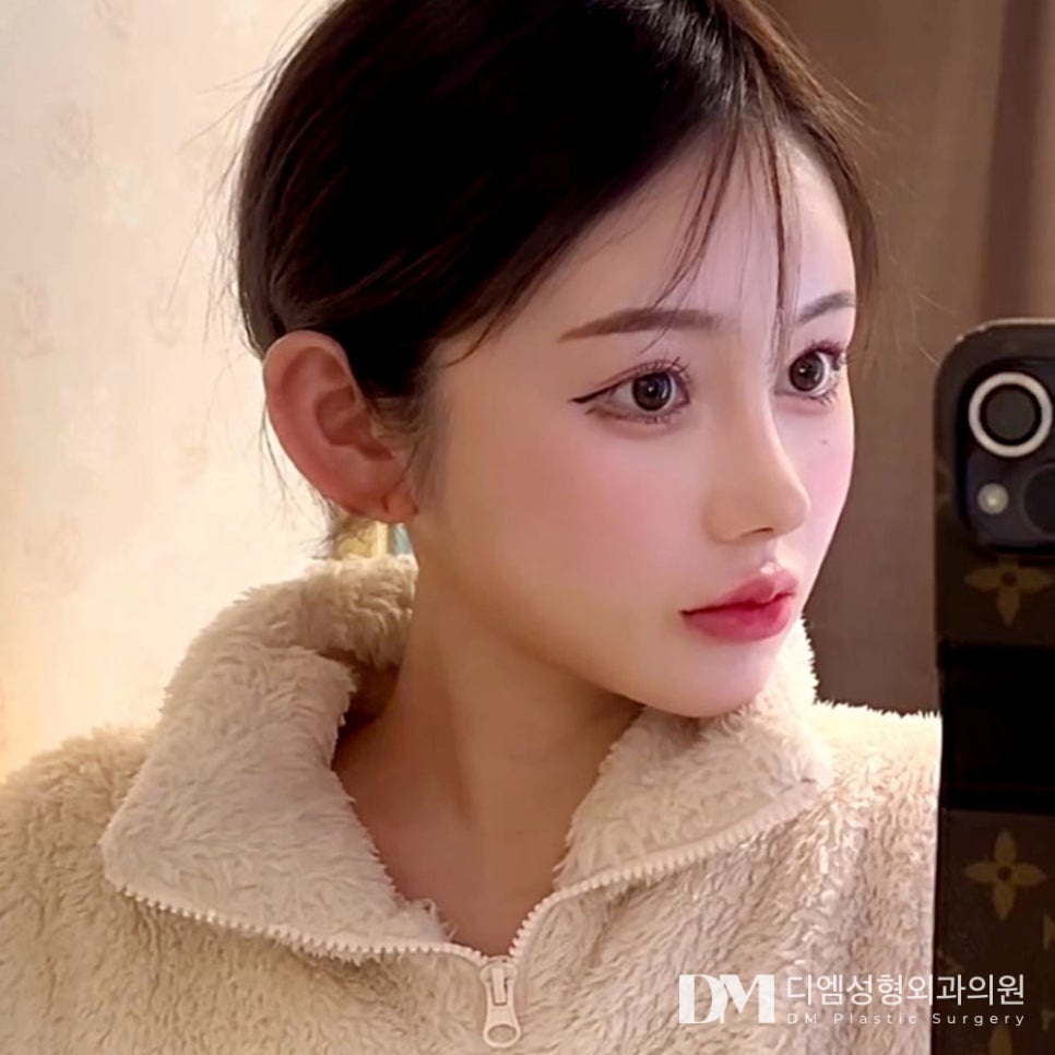 Revision Rhinoplasty: If You're Considering It image 1